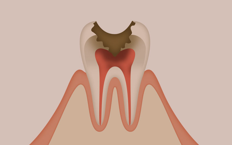 後期の虫歯