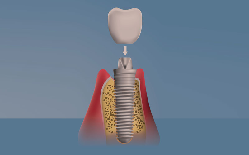 人工の歯のセット